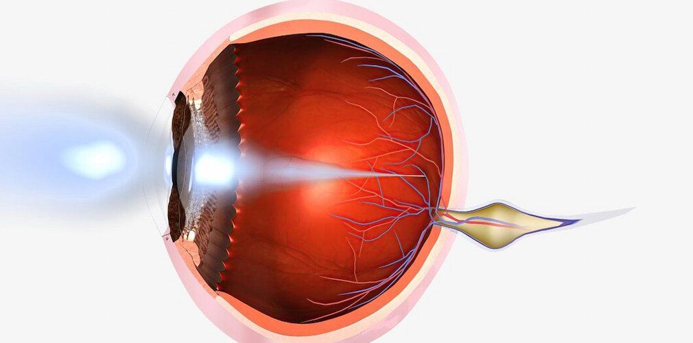 Central Retinal Vein Occlusion
