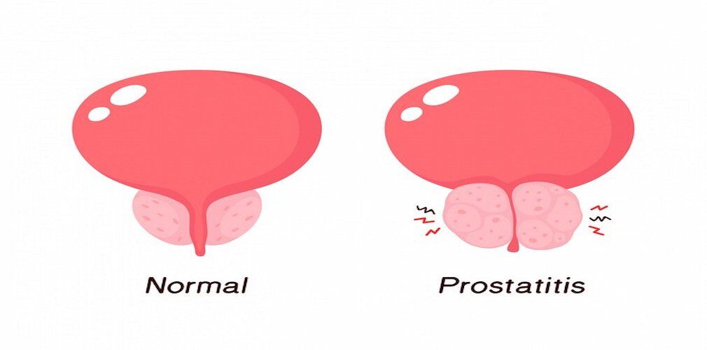 Chronic Testicular Pain