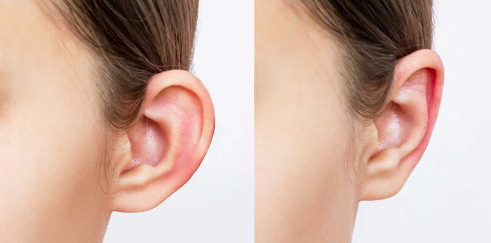 Ear Reshaping (Otoplasty)