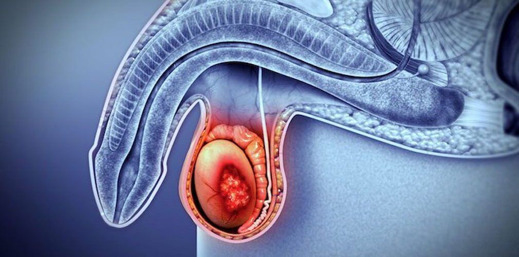 Epididymal Cyst