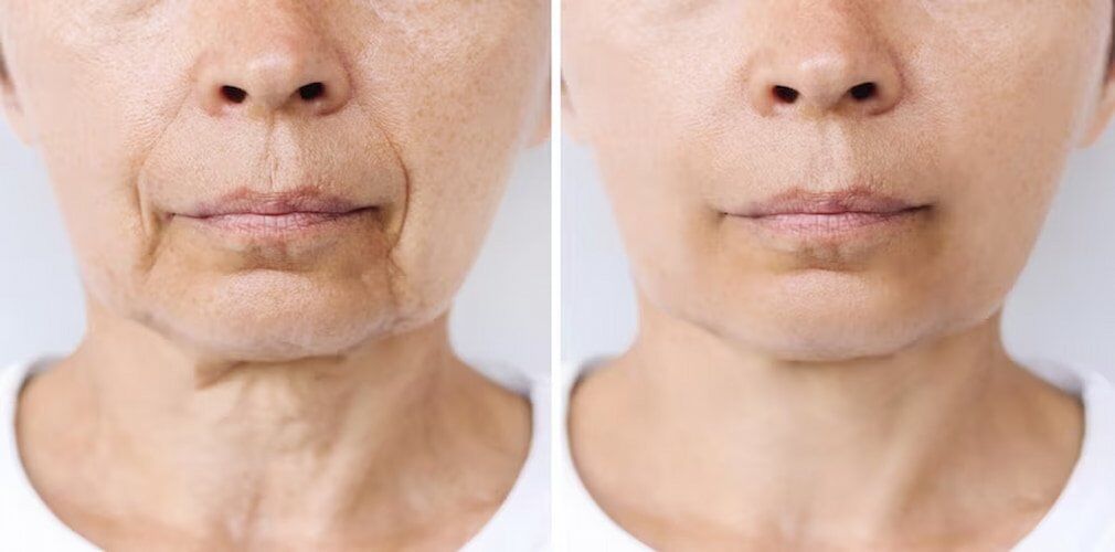 FaceLift Surgery – Rhytidectomy