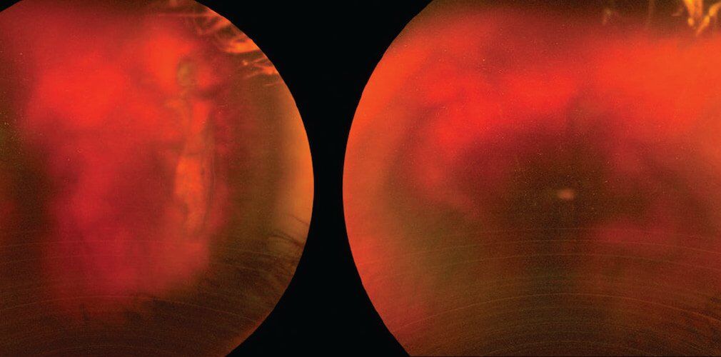 Vitreous Haemorrhage