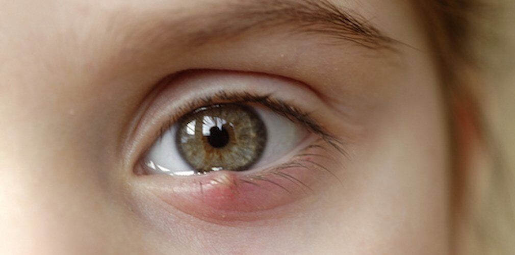 What is a Stye?