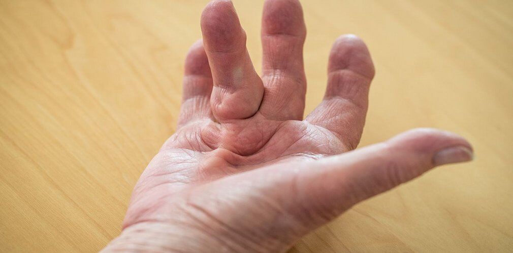 What is Dupuytren’s Contracture?