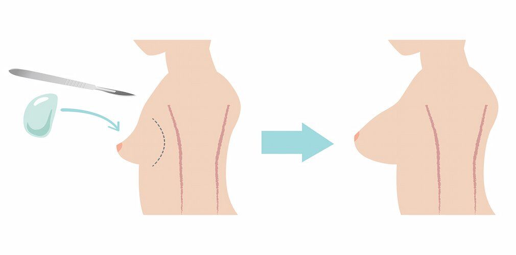 Breast Lift Surgery