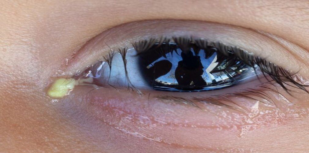 Discharge from Eyes