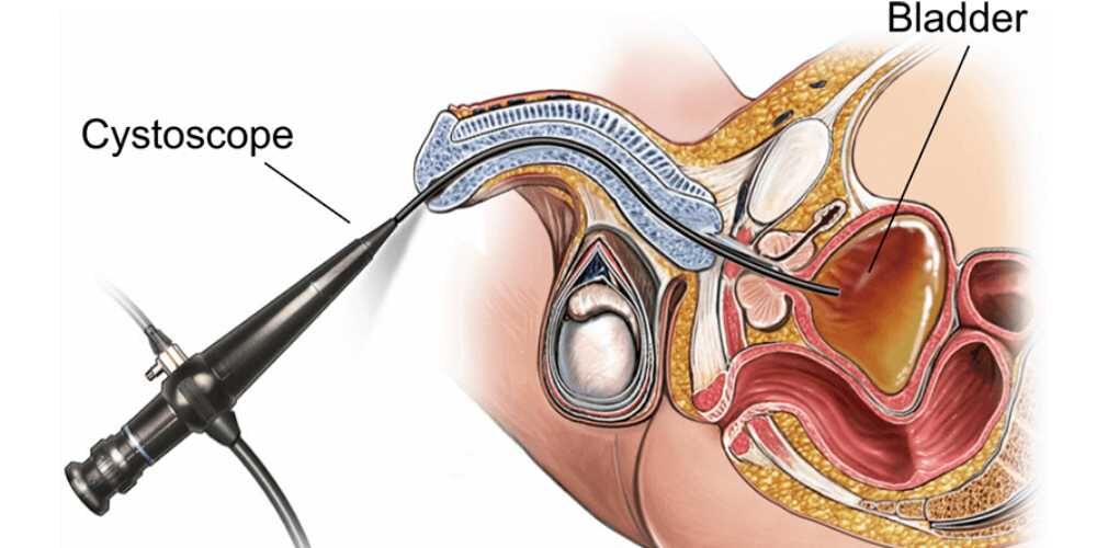 Flexible Cystoscopy (male)