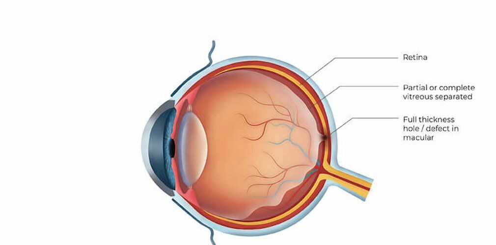 Macular Hole, Epiretinal Membrane & Vitreomacular Traction (VMT)