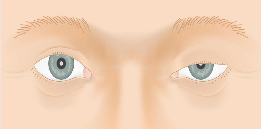 Ptosis