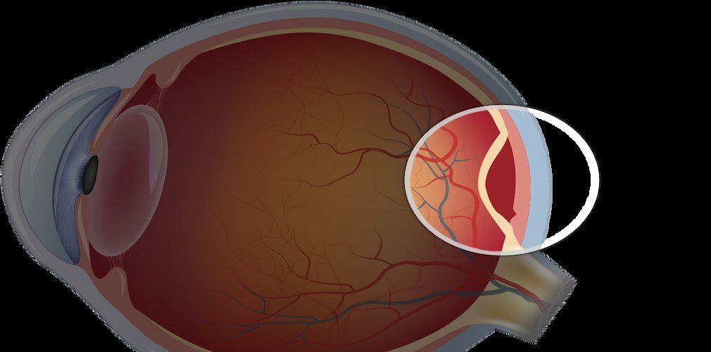 Retinal Tear or Detachment