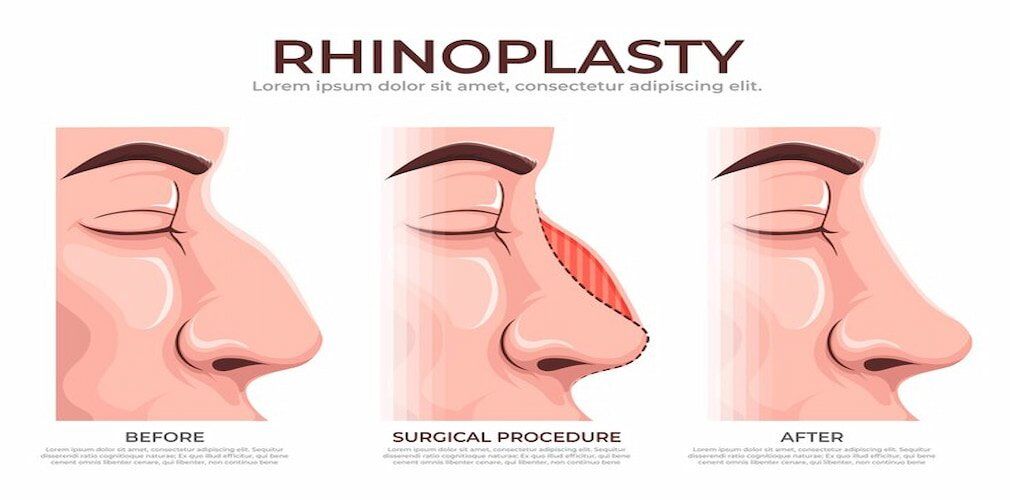 Rhinoplasty – Nose Surgery