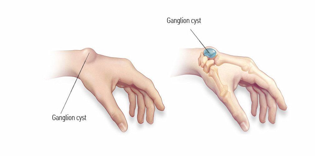 What is a Ganglion?