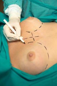 breast surgery