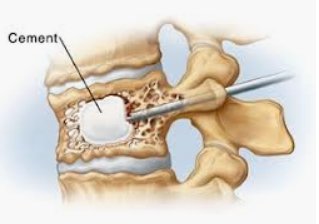 Balloon Kyphoplasty & Vertebroplasty