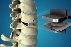 Spinal Disc Replacement