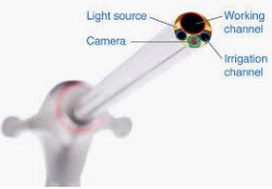 Endoscopic (Keyhole) Spinal Surgery