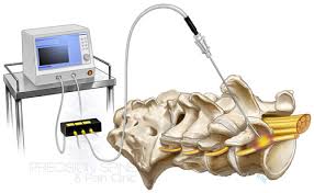 Radiofrequency Denervation