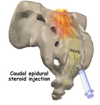 Spinal Injections