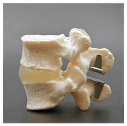 Keyhole Spinal Stenosis Day Surgery