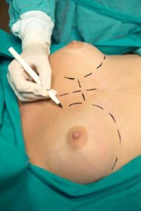 breast surgery