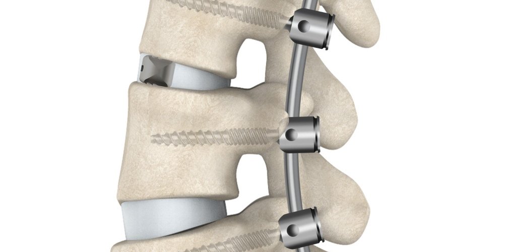 Day Surgery TLIF Lumbar Fusion