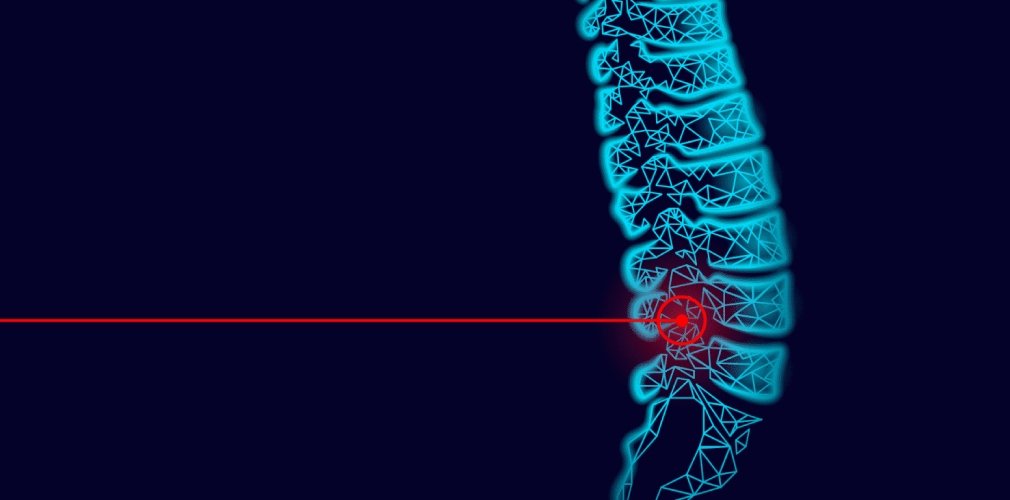 Benefits of Laser Endoscopic Spine Surgery
