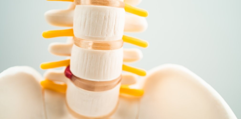 Spinal Disc Replacement